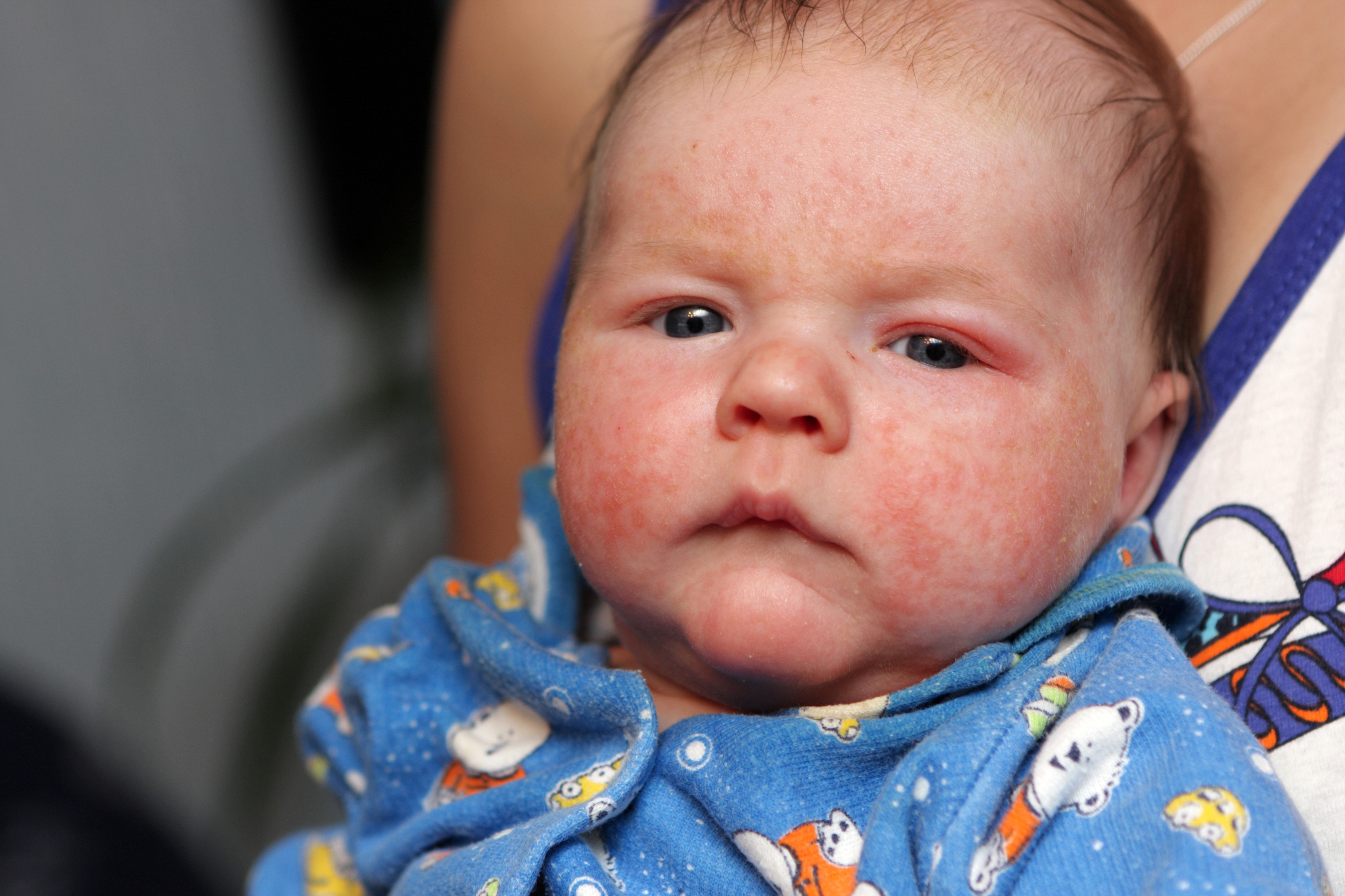 Alergia U Niemowlat Objawy Babyboom