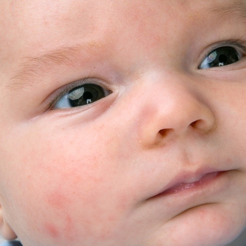 Tak wygląda trądzik niemowlęcy