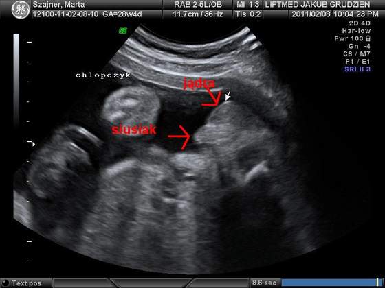 Usg Plec Dziecka Strona 4 Forum Babyboom