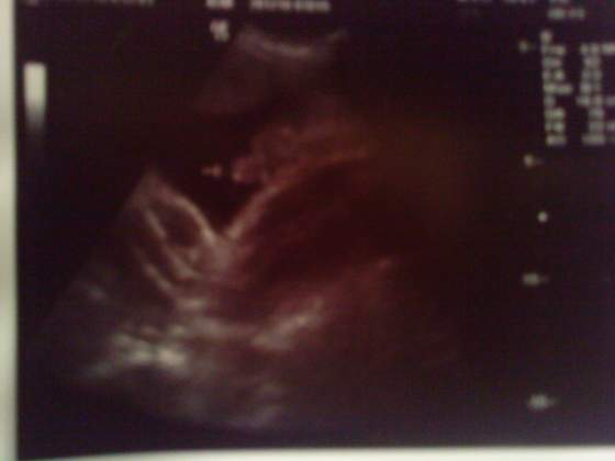 a tu dowod ze bede miala chlopca :)
widac ptaszka^^ i jedna noge :D