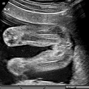 ss_week18_Girl_ultrasound.jpg